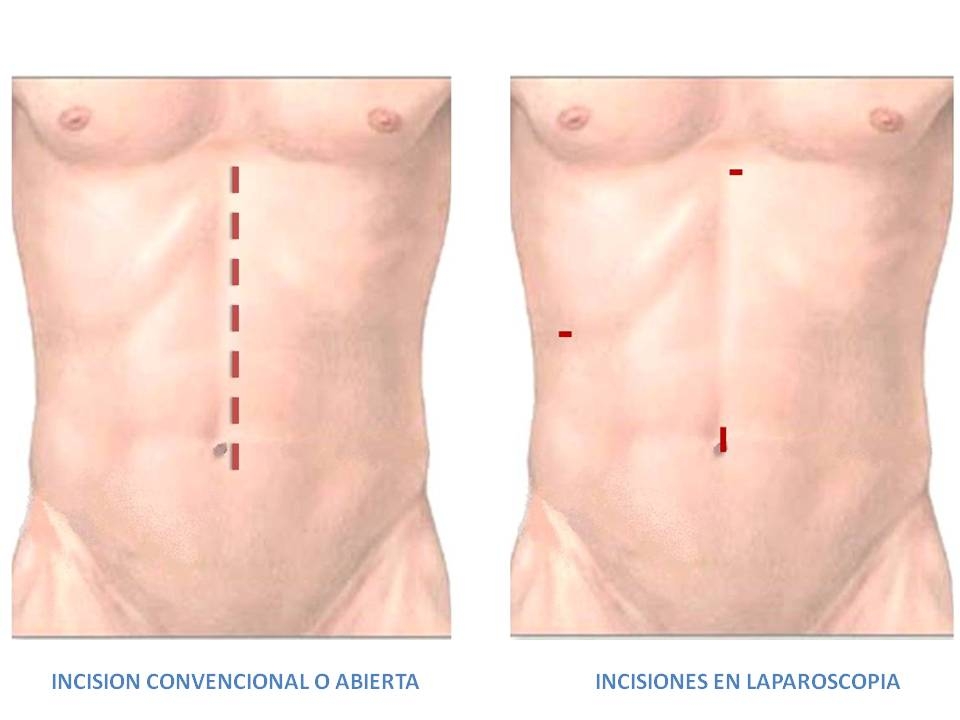cirugia laparoscopica dominicana
